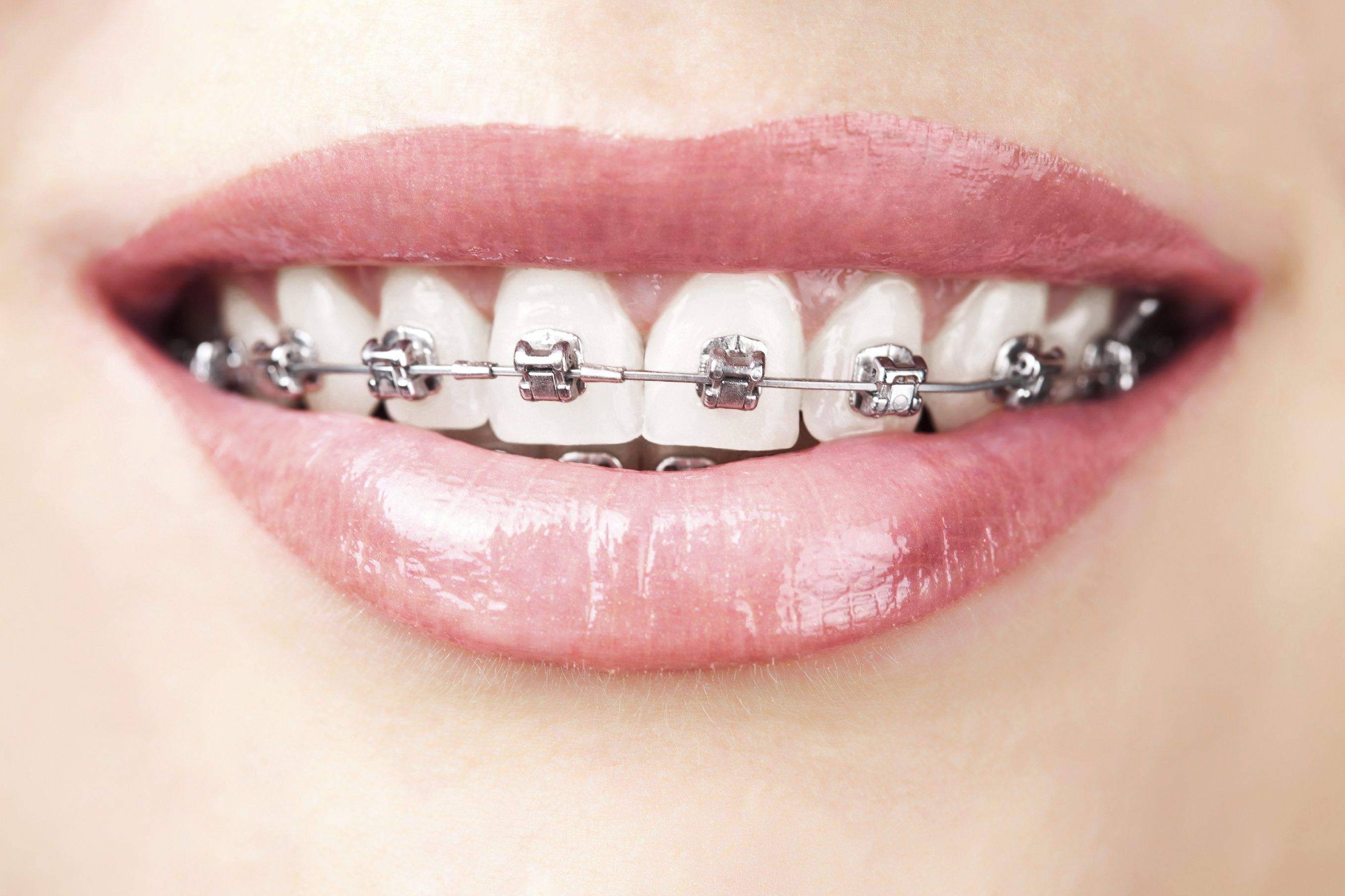 Close up of traditional orthodontics and woman's smile