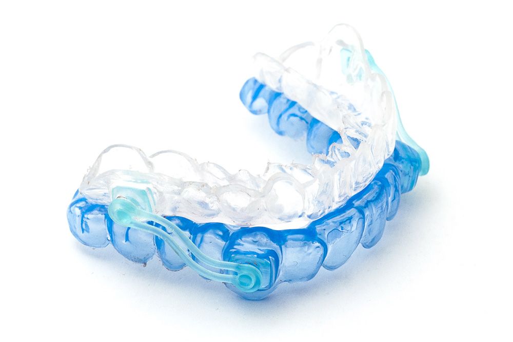 A custom-made oral sleep apnea appliance