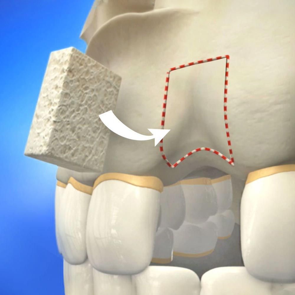 Illustration of bone graft procedure