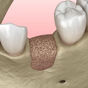 Illustration of bone graft with synthetic materials