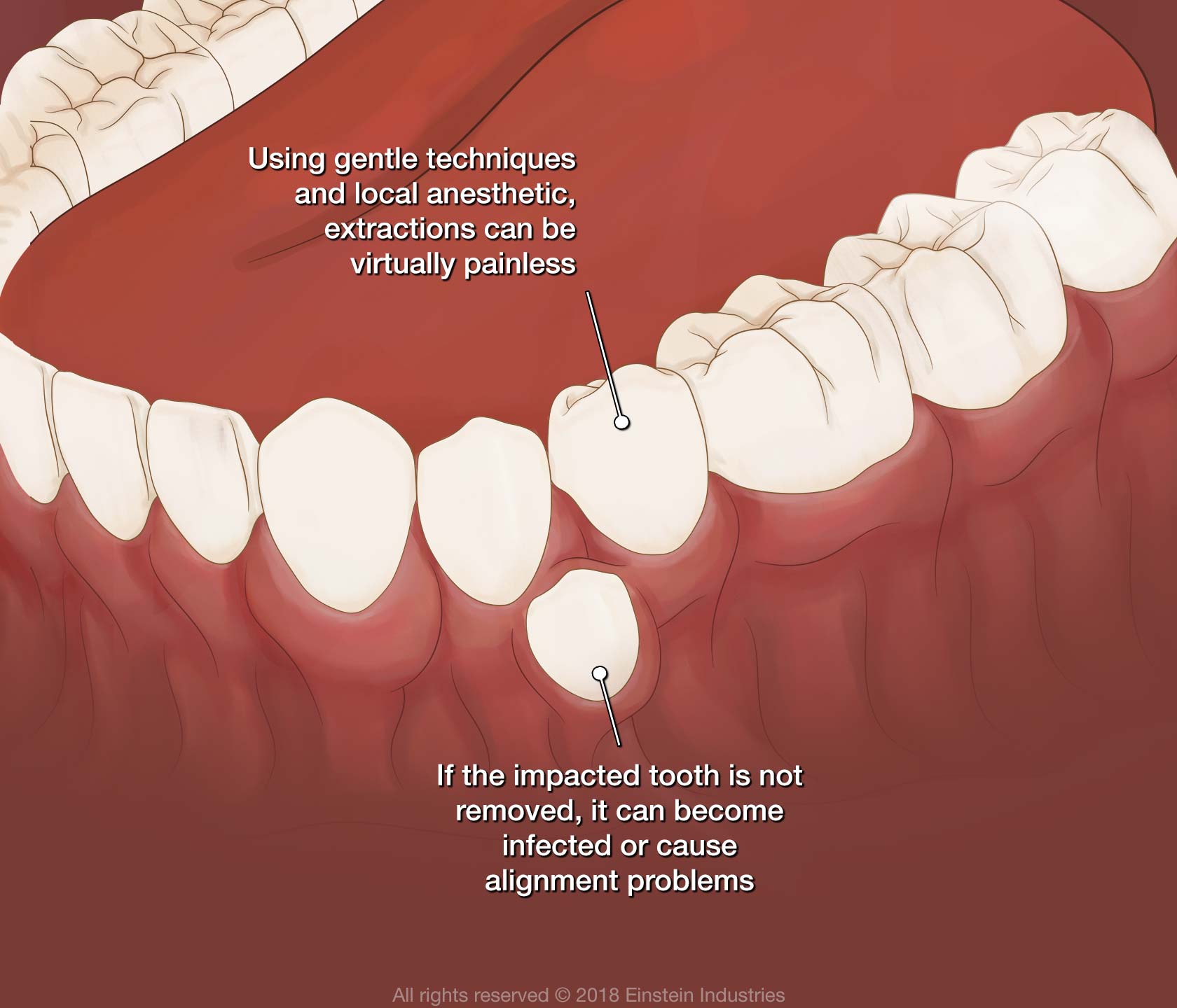 Using gentle techniques and local anesthetic, extractions can be virtually painless. If the impacted tooth is not removed, it can become infected or cause alignment problems.