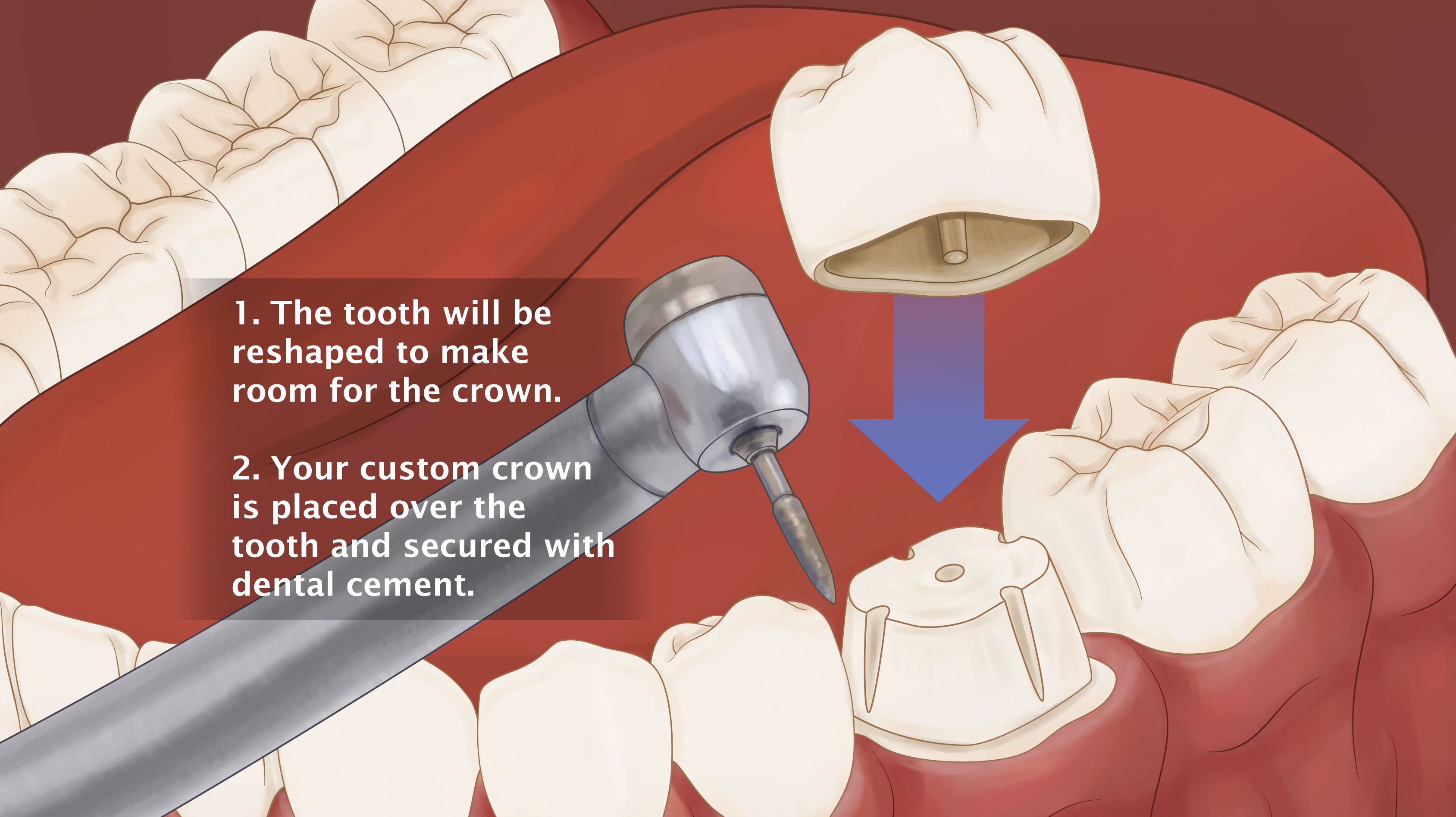 dental crown placement