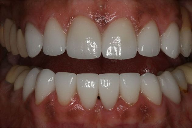 Smile Montreal Patient After Porcelain Veneers procedure